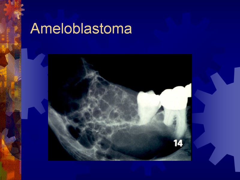 Ameloblastoma